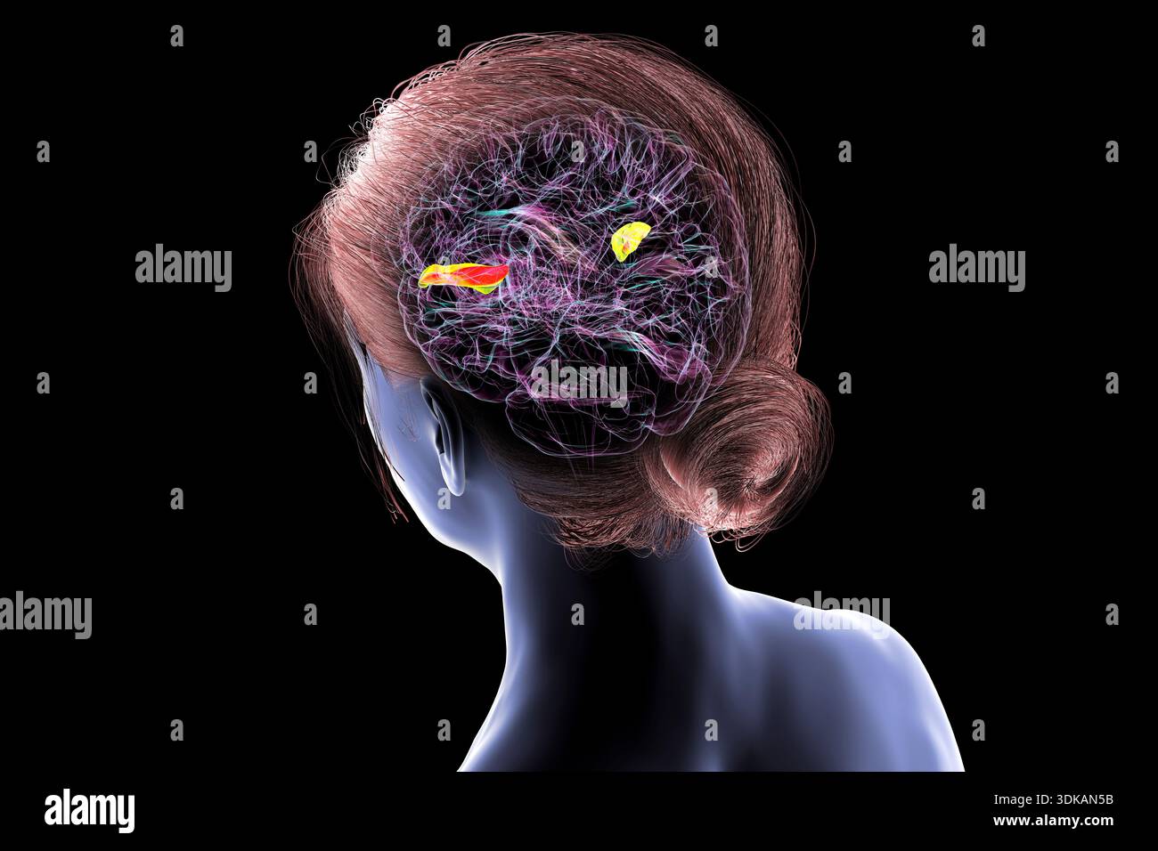 Illustration of a human brain with the transverse temporal gyri ...