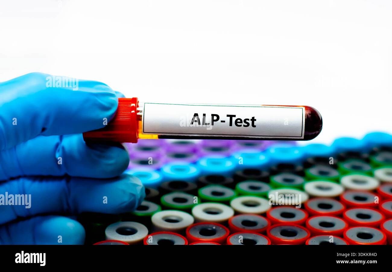 Alp blood test hi-res stock photography and images - Alamy