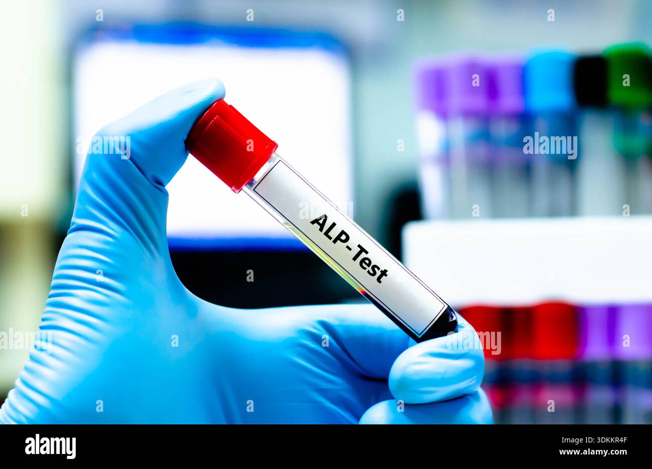 Alp blood test hi-res stock photography and images - Alamy