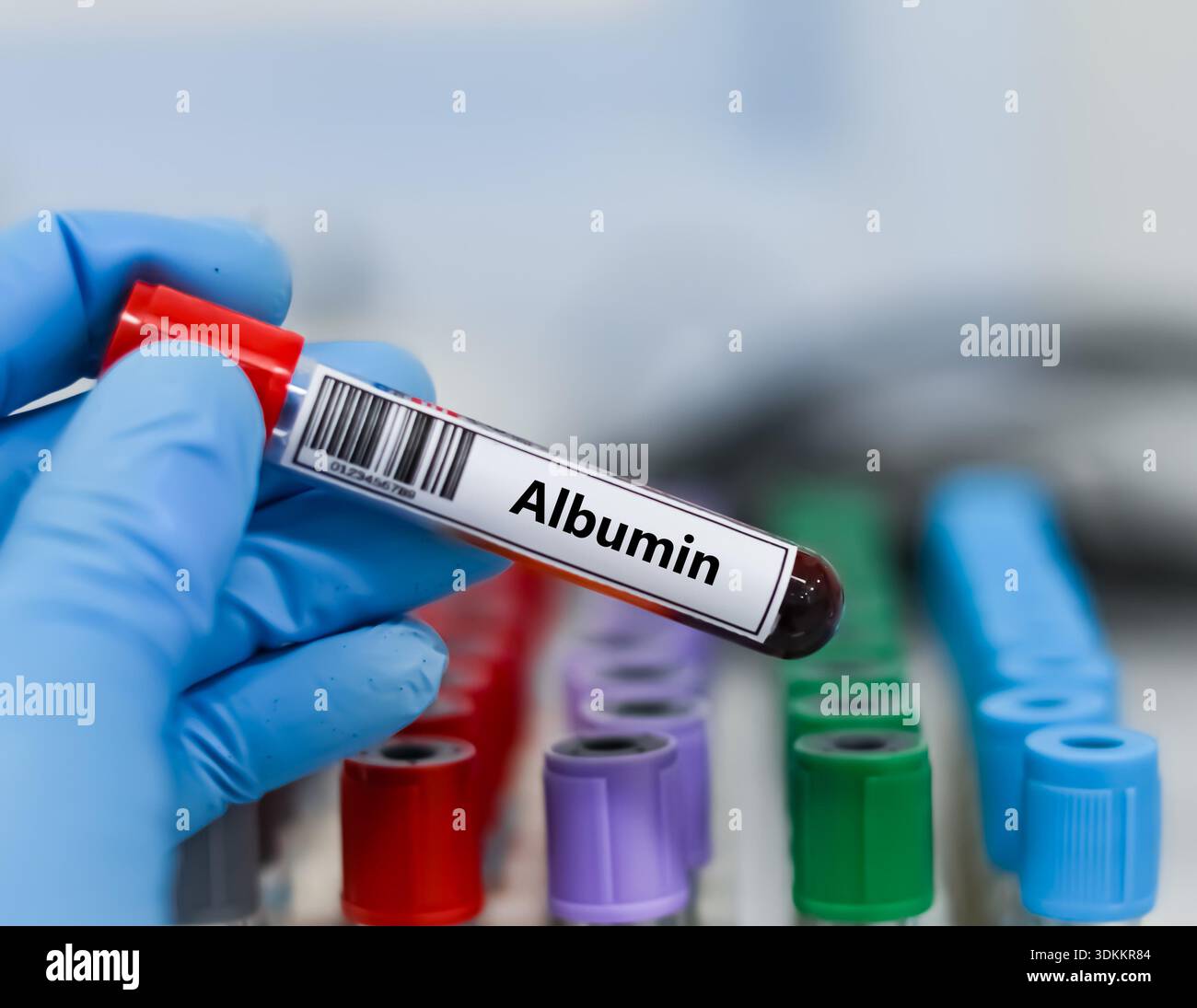 Blood sample tube for albumin test analysis Stock Photo - Alamy