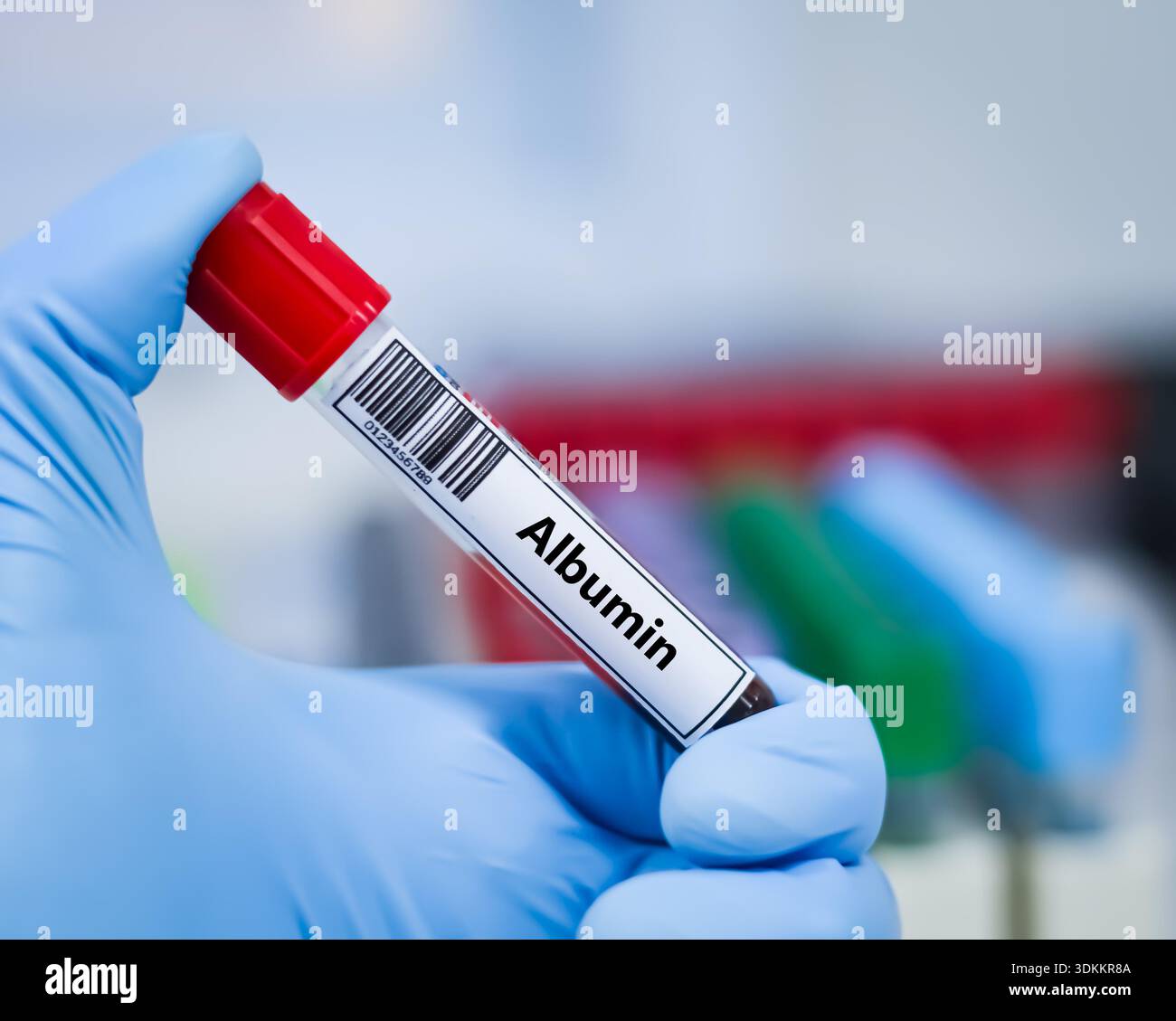 Blood sample tube for albumin test analysis Stock Photo - Alamy