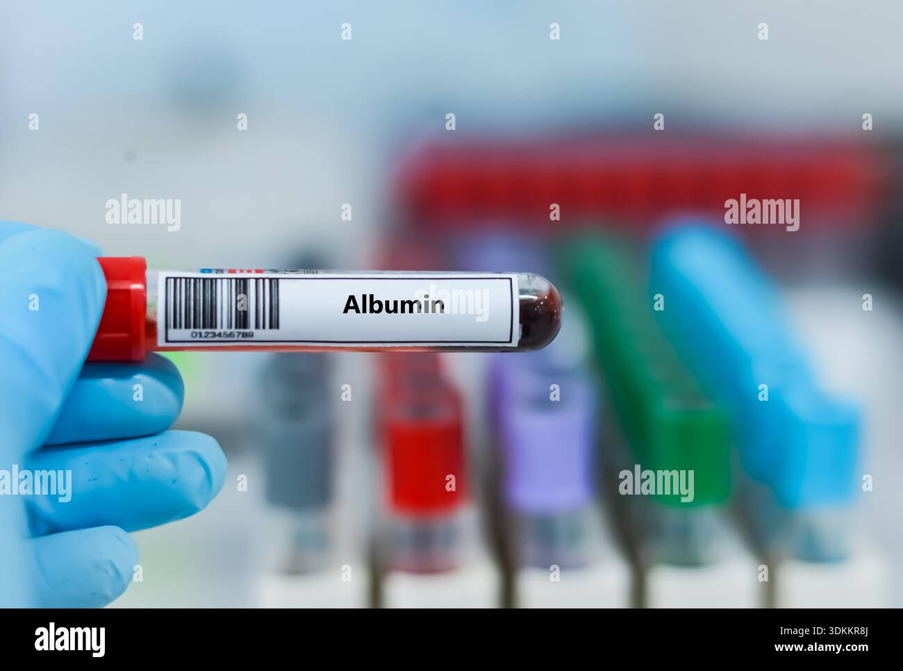 Blood sample tube for albumin test analysis Stock Photo - Alamy