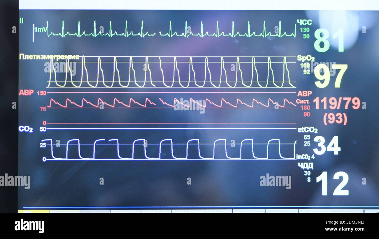 Low O2 Monitor Hospital Oxygen saturation curve hi-res stock photography and images - Alamy