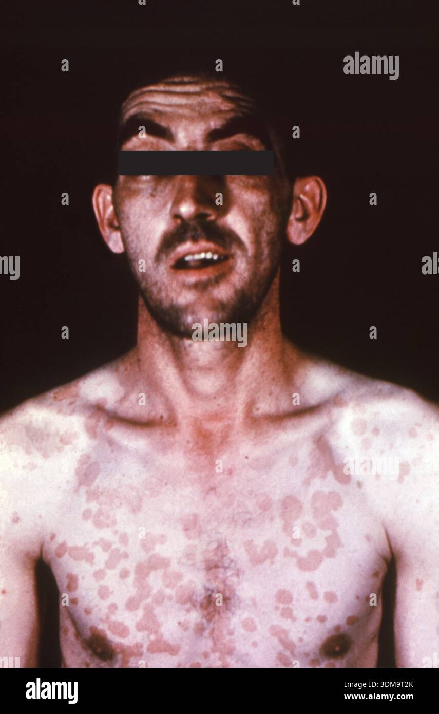 An anterior view of a male patient's face and chest shows a macular ...