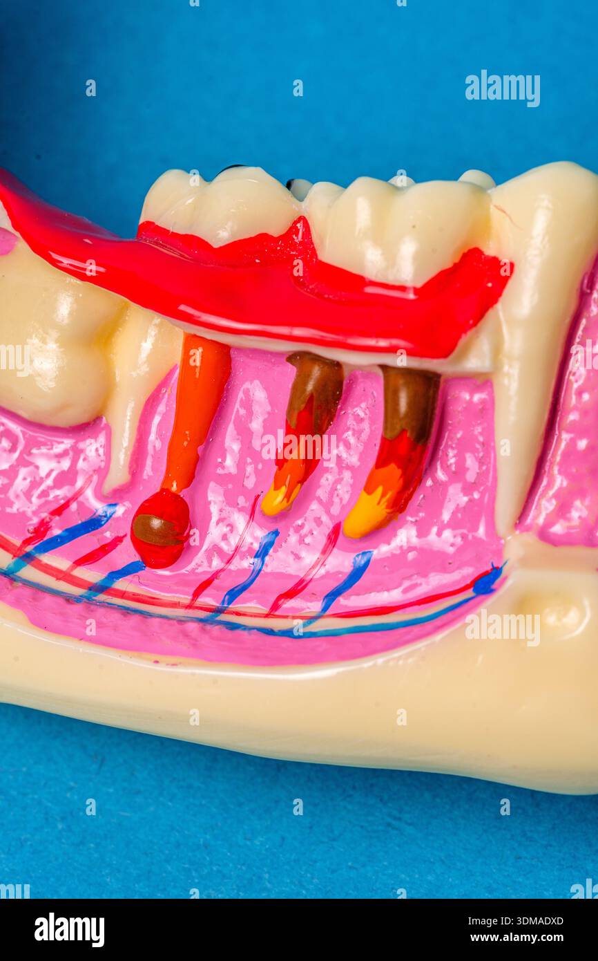 Dental disease model showing gum recession and tooth decay Stock Photo ...