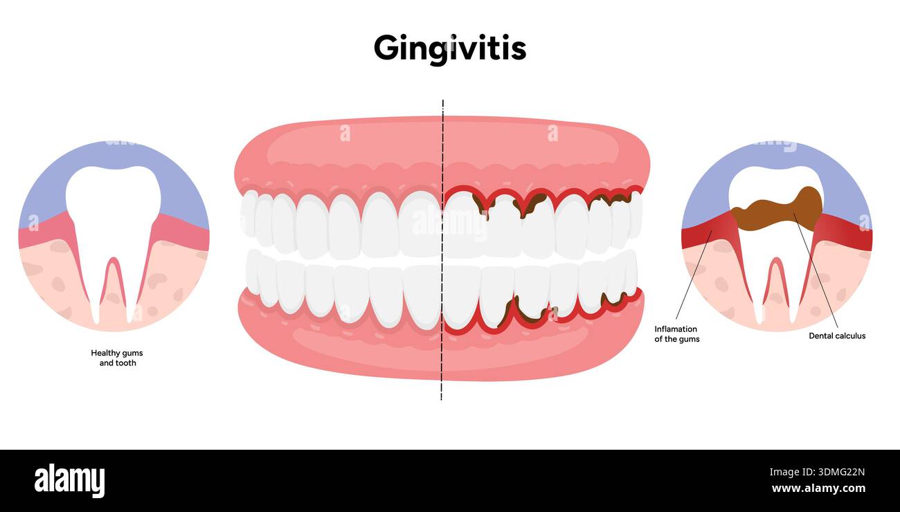 Tooth Edema Hand-drawn dental illustration teeth with gingivitis with signs and ...