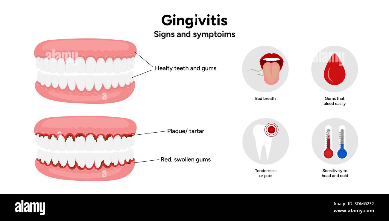 Tooth Edema Hand-drawn dental illustration teeth with gingivitis with signs and ...