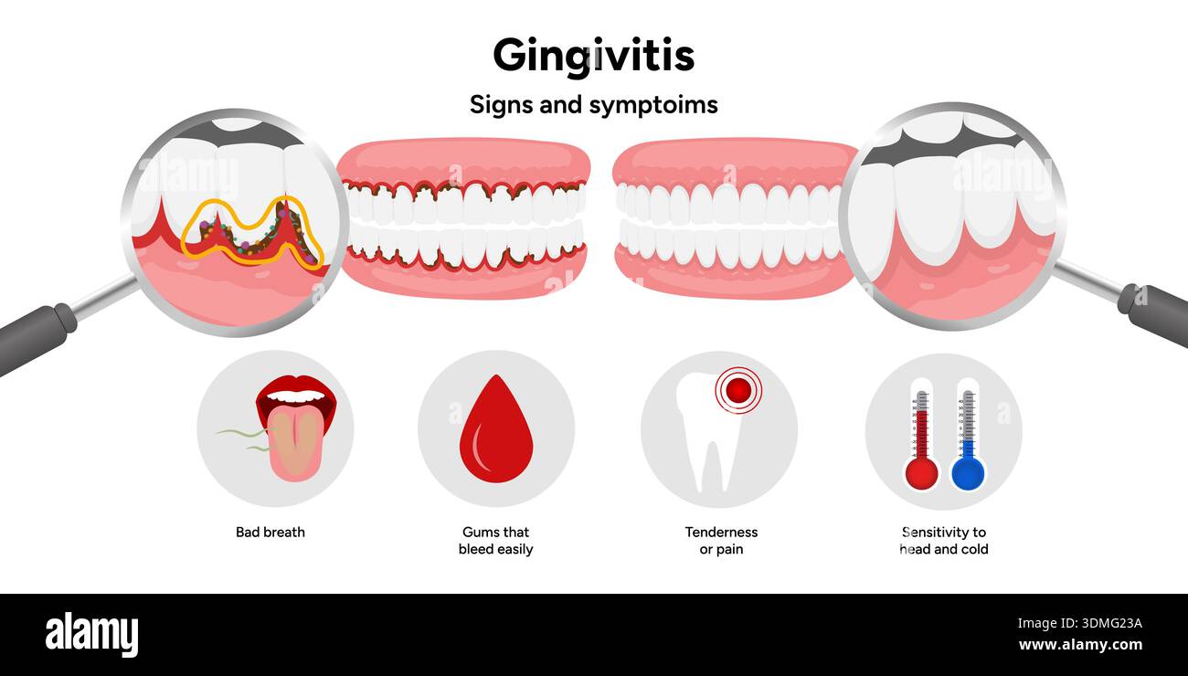 Tooth Edema Hand-drawn dental illustration teeth with gingivitis with signs and ...