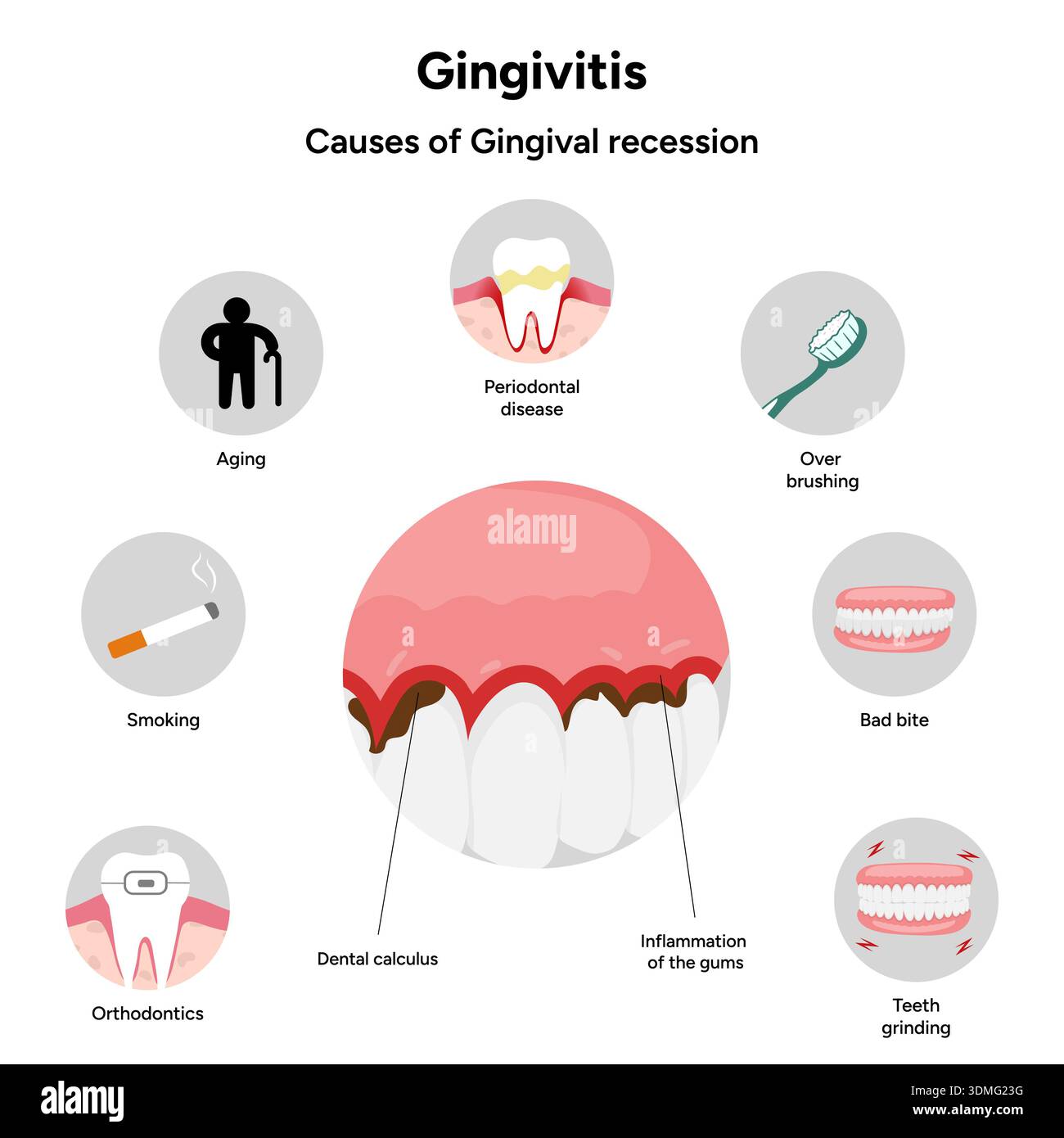 Tooth Edema Hand-drawn dental illustration teeth with gingivitis with signs and ...
