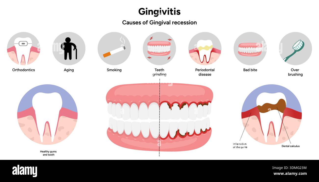 Tooth Edema Hand-drawn dental illustration teeth with gingivitis with signs and ...