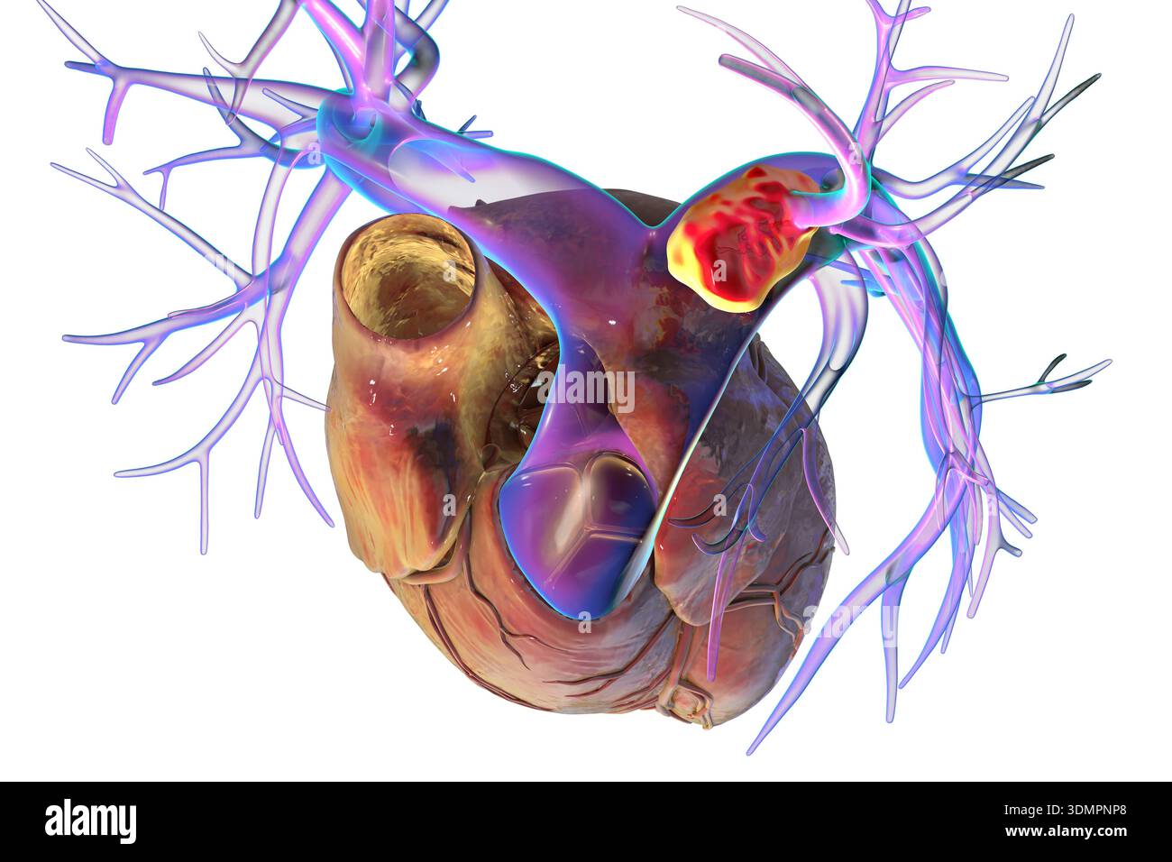 Illustration of a left pulmonary embolism, showing an embolus (clot) in ...