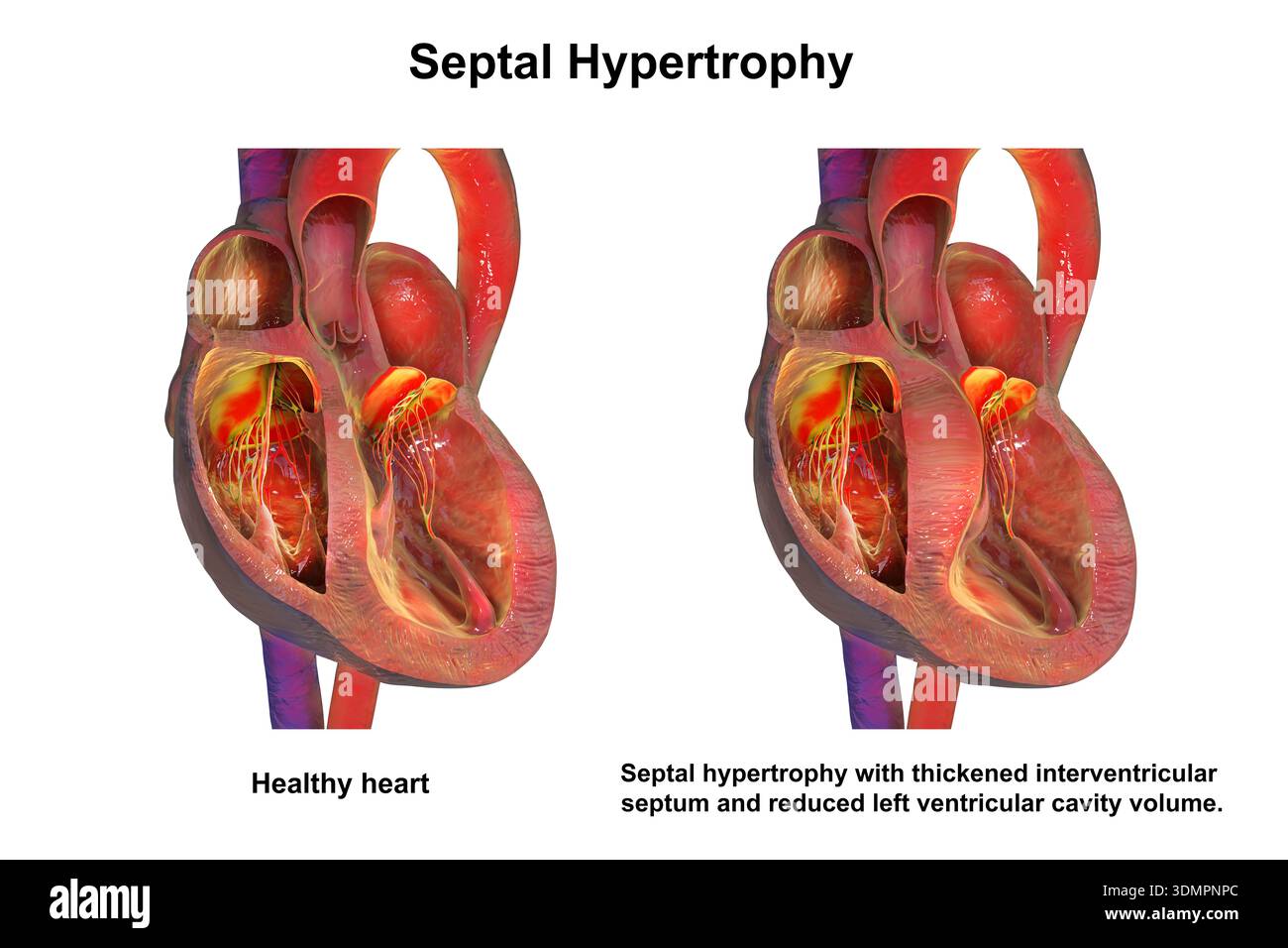 septal-hypertrophy-in-heart-hi-res-stock-photography-and-images-alamy