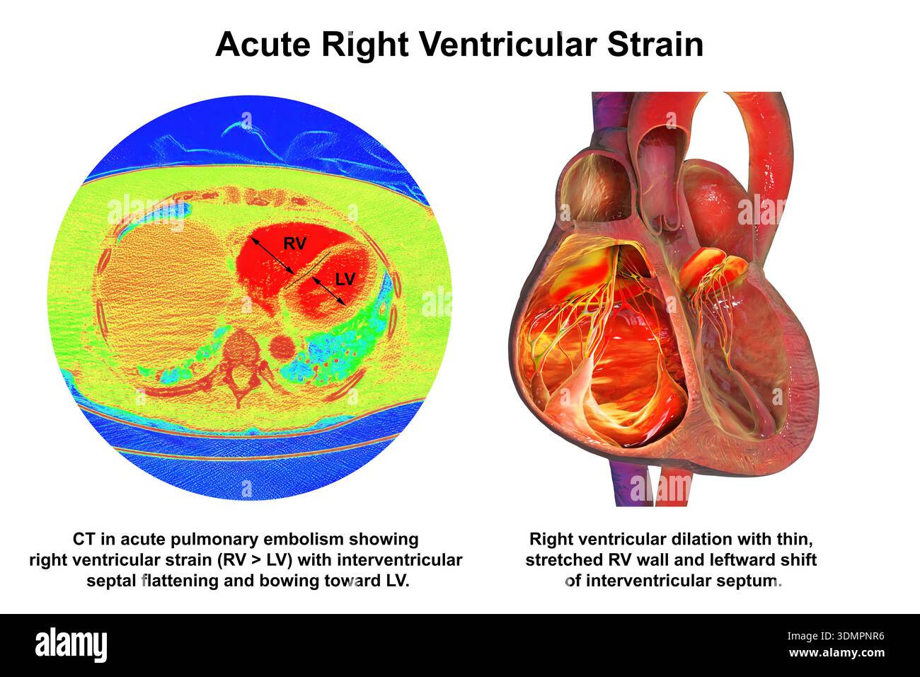Illustration of right ventricular dilation showing a CT scan (left) and ...