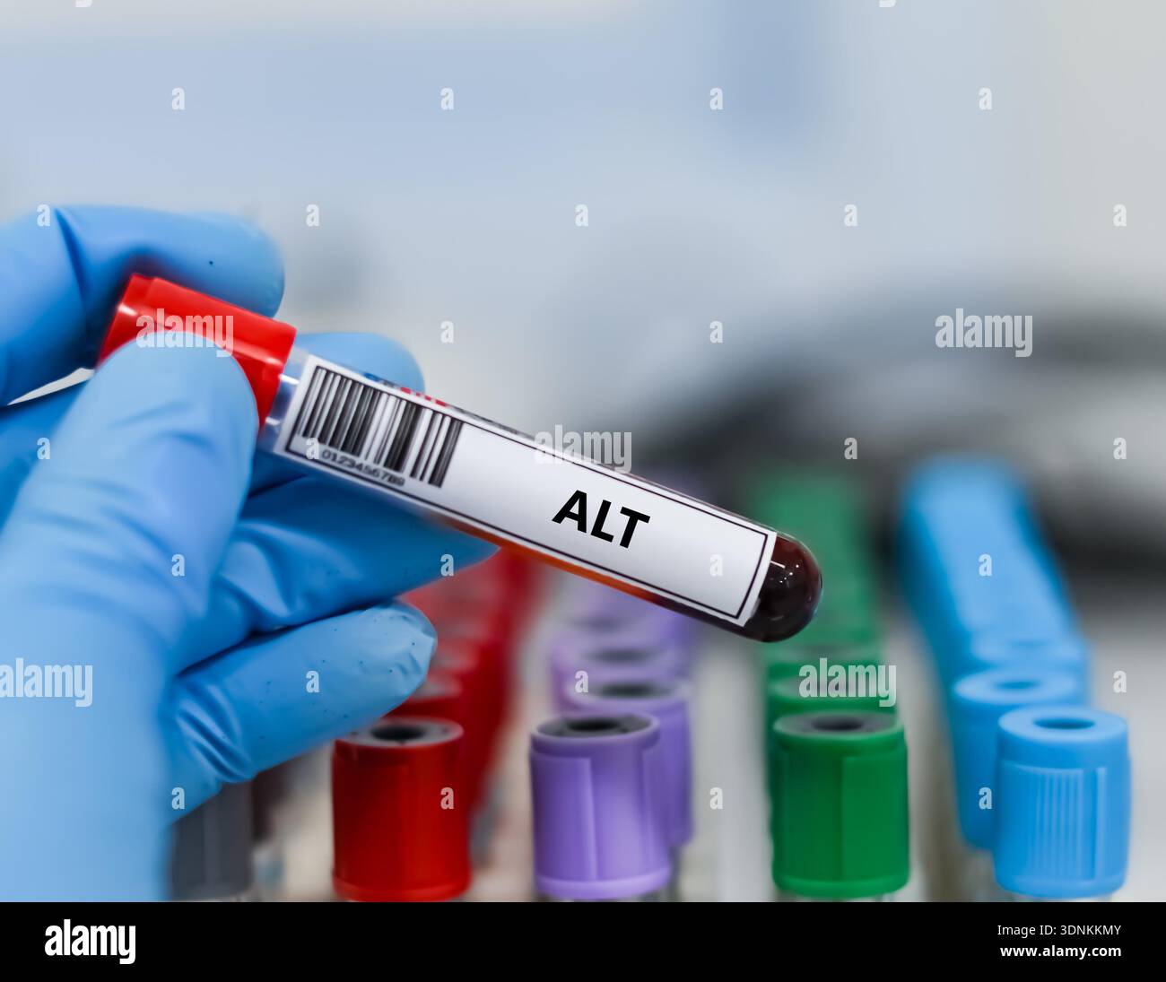 Blood sample tube for alanine transaminase (ALT) test analysis Stock ...