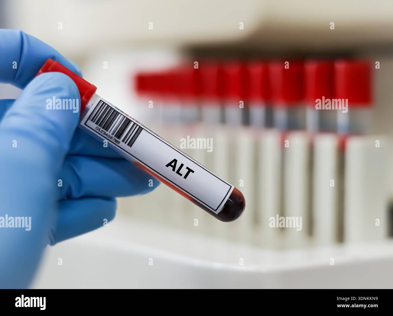Blood sample tube for alanine transaminase (ALT) test analysis Stock ...