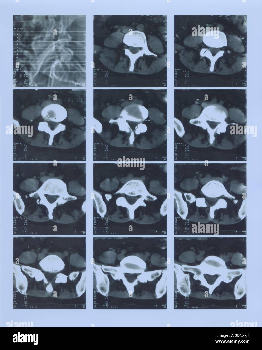 Spine CT scan film sheet, multiple cross section images of vertebra ...