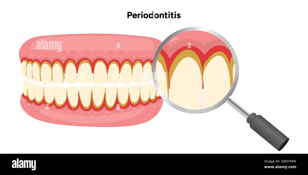 Upper and lower rows of teeth with periodontal problems to healthy ...
