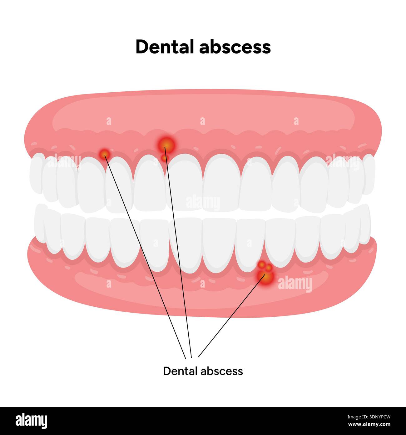 Hand-drawn dental illustration tooth with a dental abscess, visible ...
