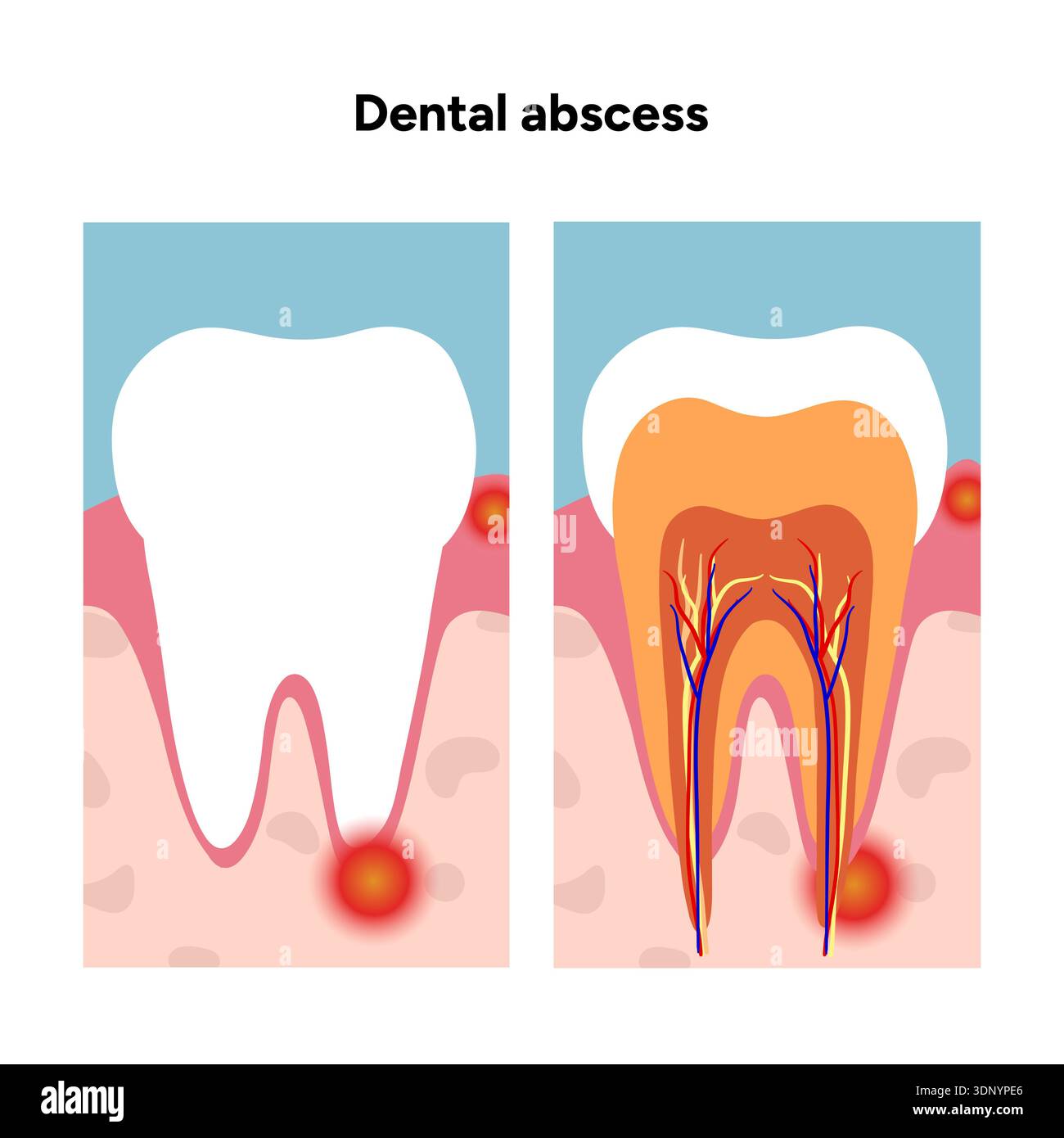 Hand-drawn dental illustration tooth with a dental abscess, visible ...