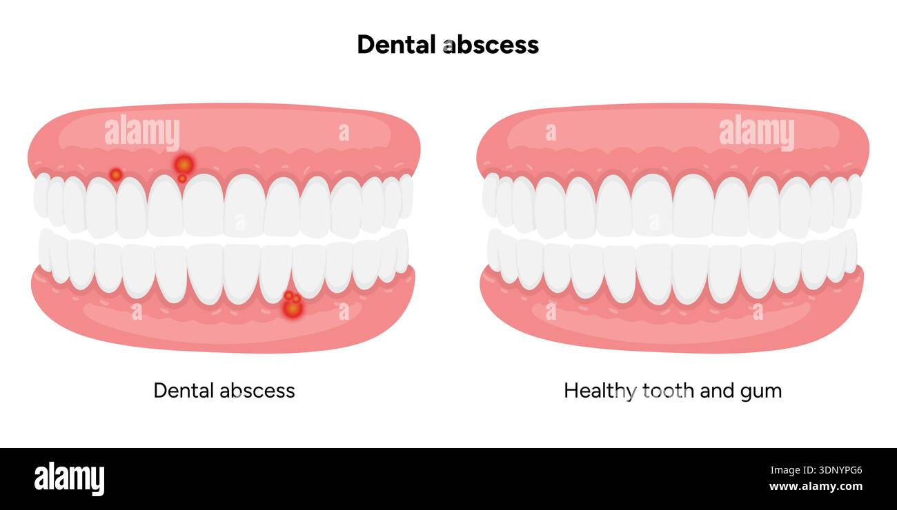 Hand-drawn dental illustration tooth with a dental abscess, visible ...