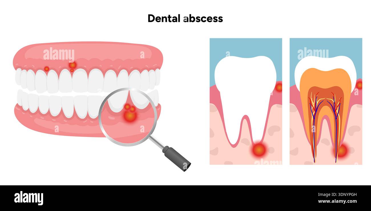Hand-drawn dental illustration tooth with a dental abscess, visible ...