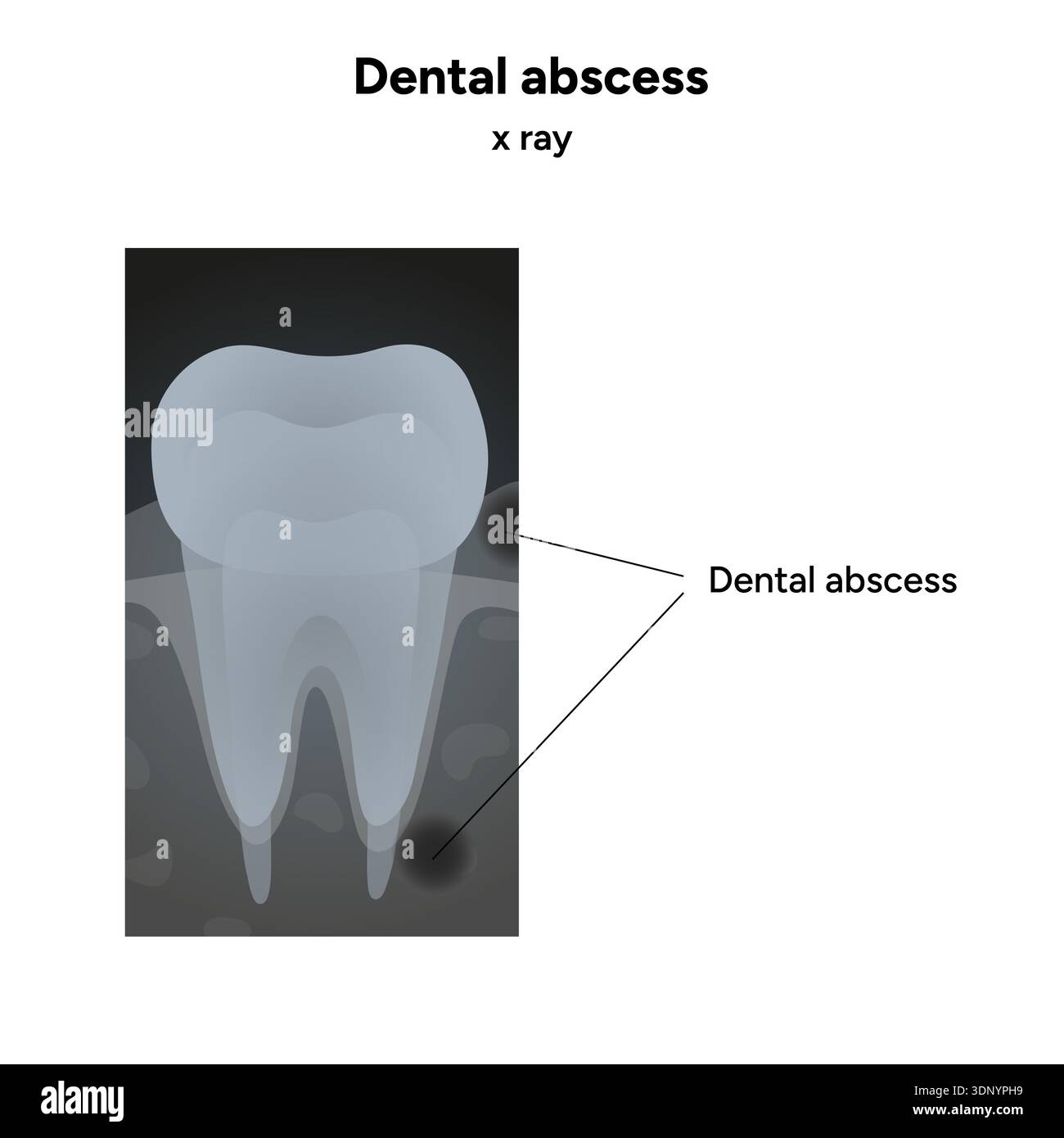 Hand-drawn dental illustration tooth with a dental abscess, visible ...