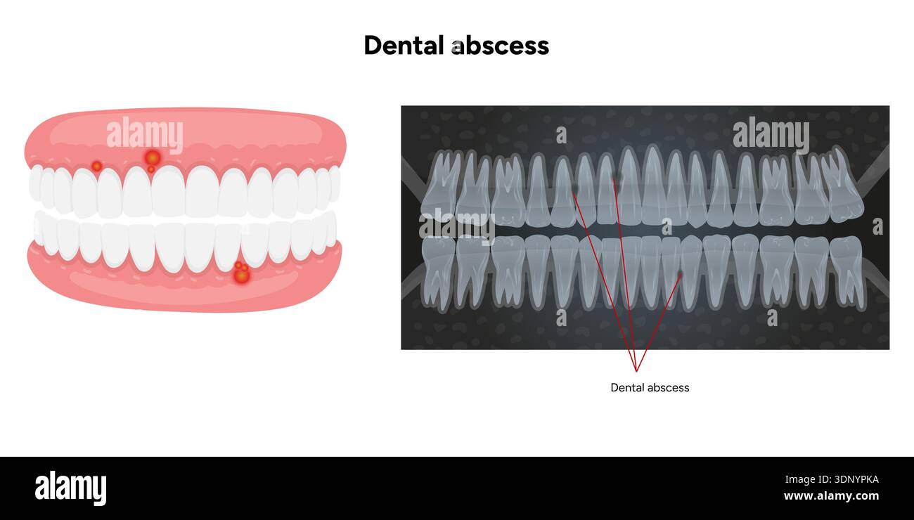Hand-drawn dental illustration tooth with a dental abscess, visible ...