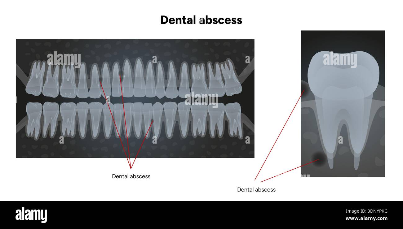 Hand-drawn dental illustration tooth with a dental abscess, visible ...