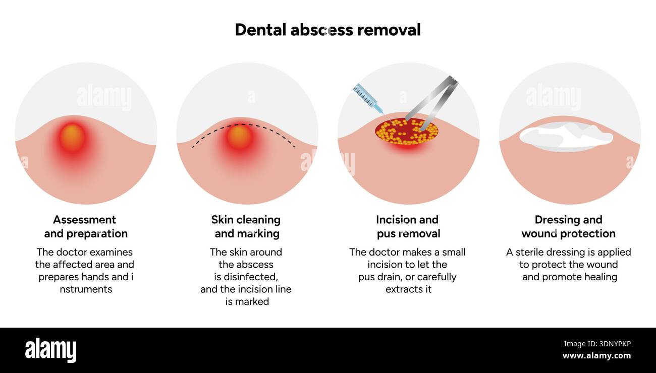 Hand-drawn dental illustration showing the process of dental abscess ...
