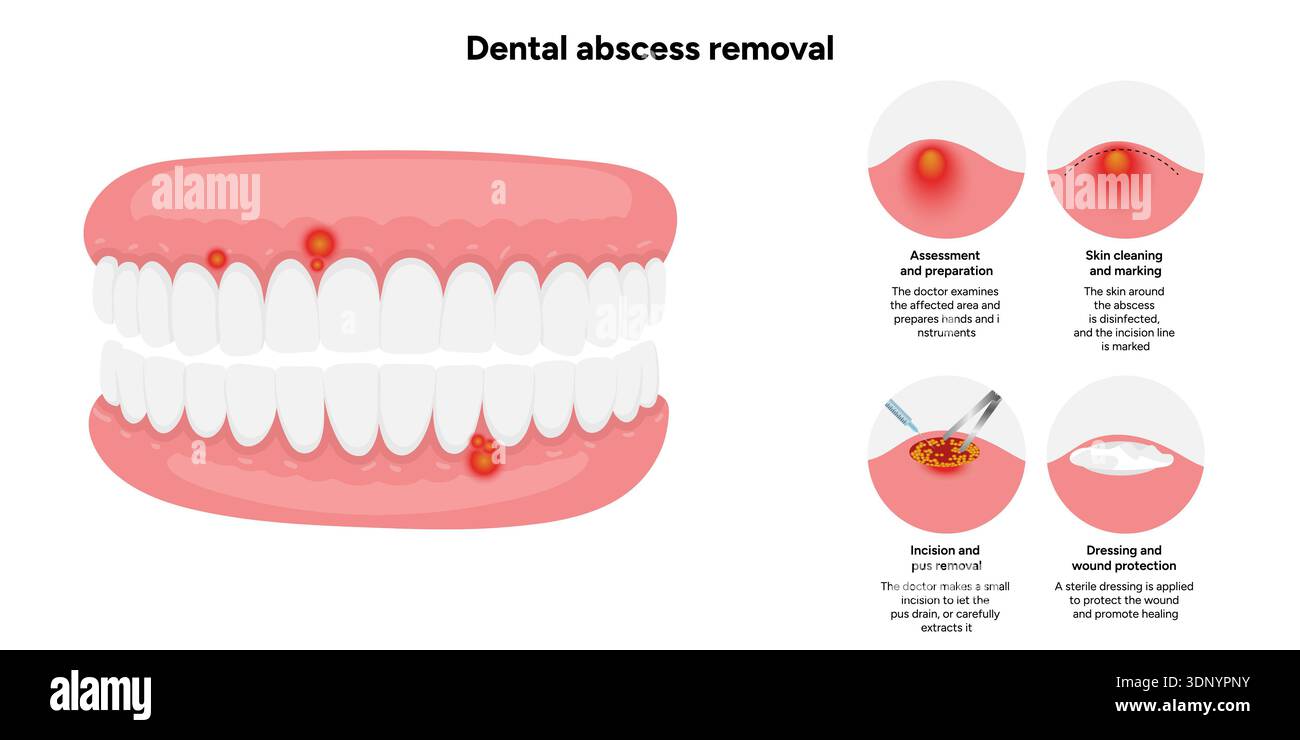 Hand-drawn dental illustration showing the process of dental abscess ...
