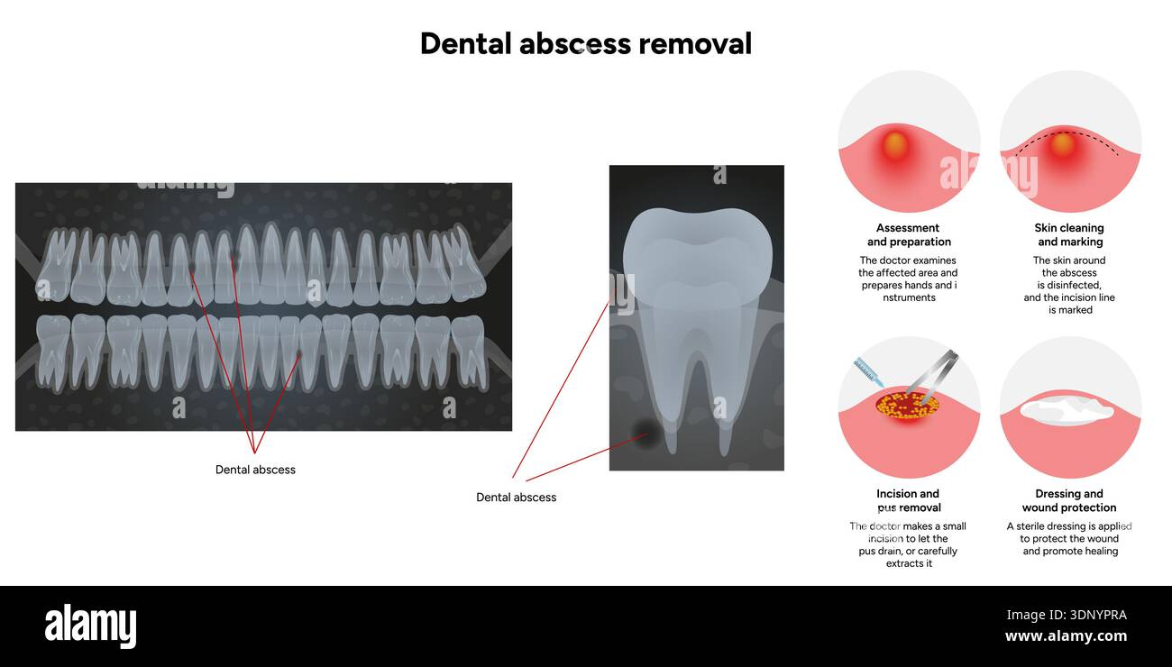 Hand-drawn dental illustration showing the process of dental abscess ...