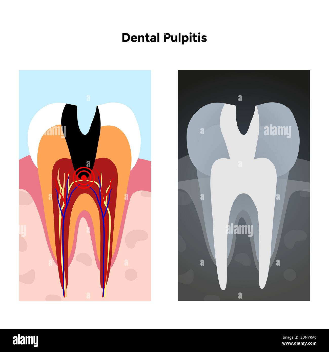 Hand-drawn dental infographic of pulpitis X-ray internal anatomy of ...
