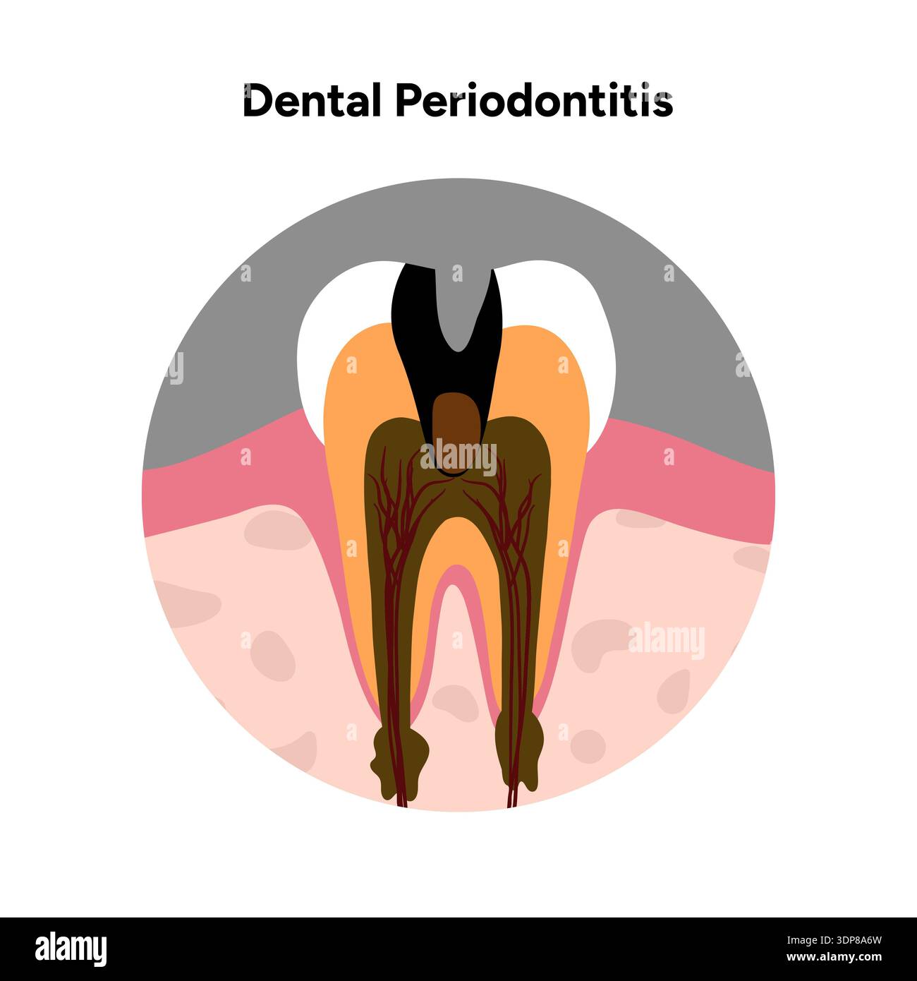 Tooth Infection Skeleton Hand-drawn dental infographic illustrating periodontitis. Inflammation ...
