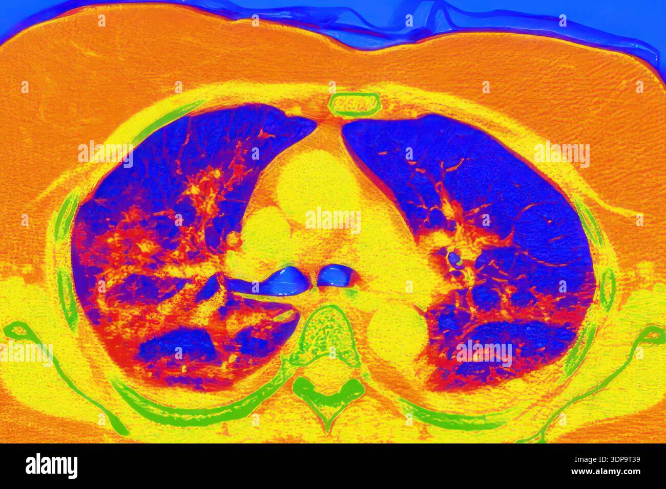 Coloured chest x ray hi-res stock photography and images - Alamy