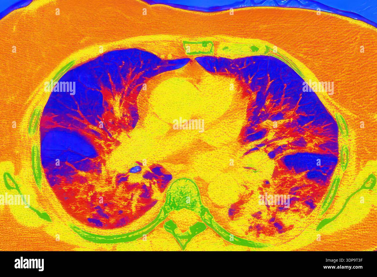 Coloured computed tomography (CT) scan of an axial section of human ...