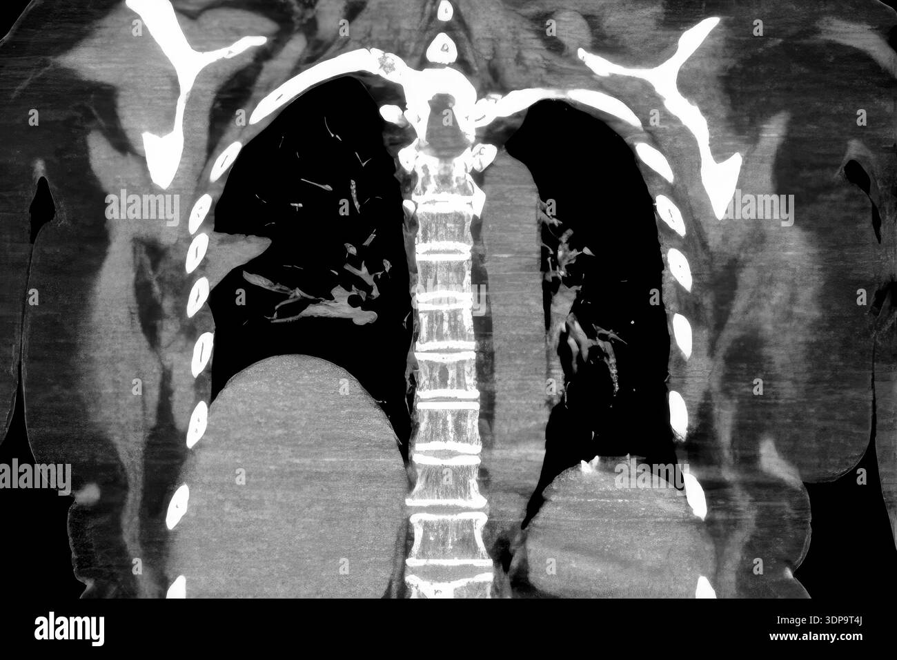 Wedge Infarction CT scan showing wedge-shaped pulmonary infarction in right lung (left ...