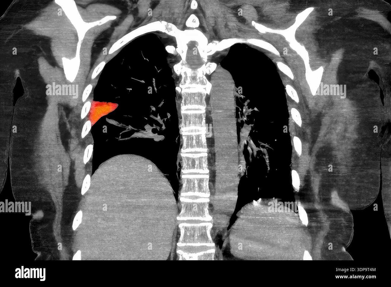 Wedge Infarction Colour-enhanced CT scan showing wedge-shaped pulmonary infarction in ...