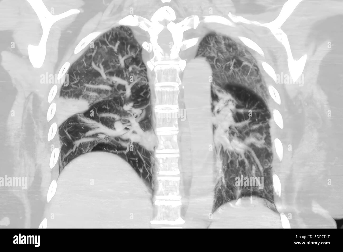 Wedge Infarction CT scan showing wedge-shaped pulmonary infarction in right lung (left ...