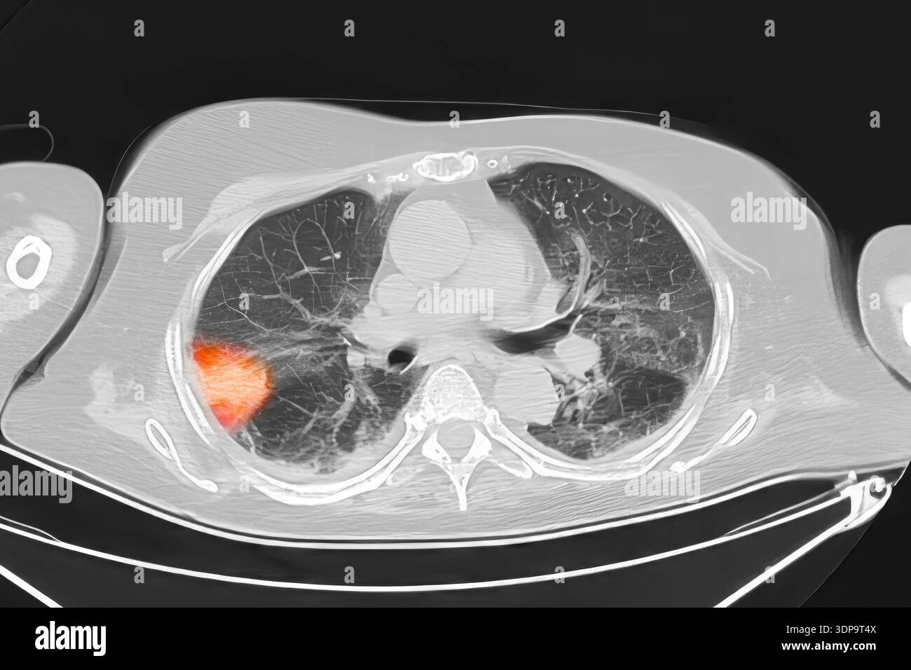 Rd Infraction Example Pulmonary embolism ct scan hi-res stock photography and images - Alamy