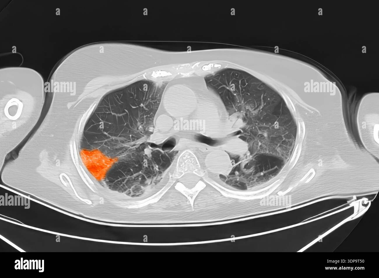 Lng Infarction CT scan showing wedge-shaped pulmonary infarction in the right lung ...