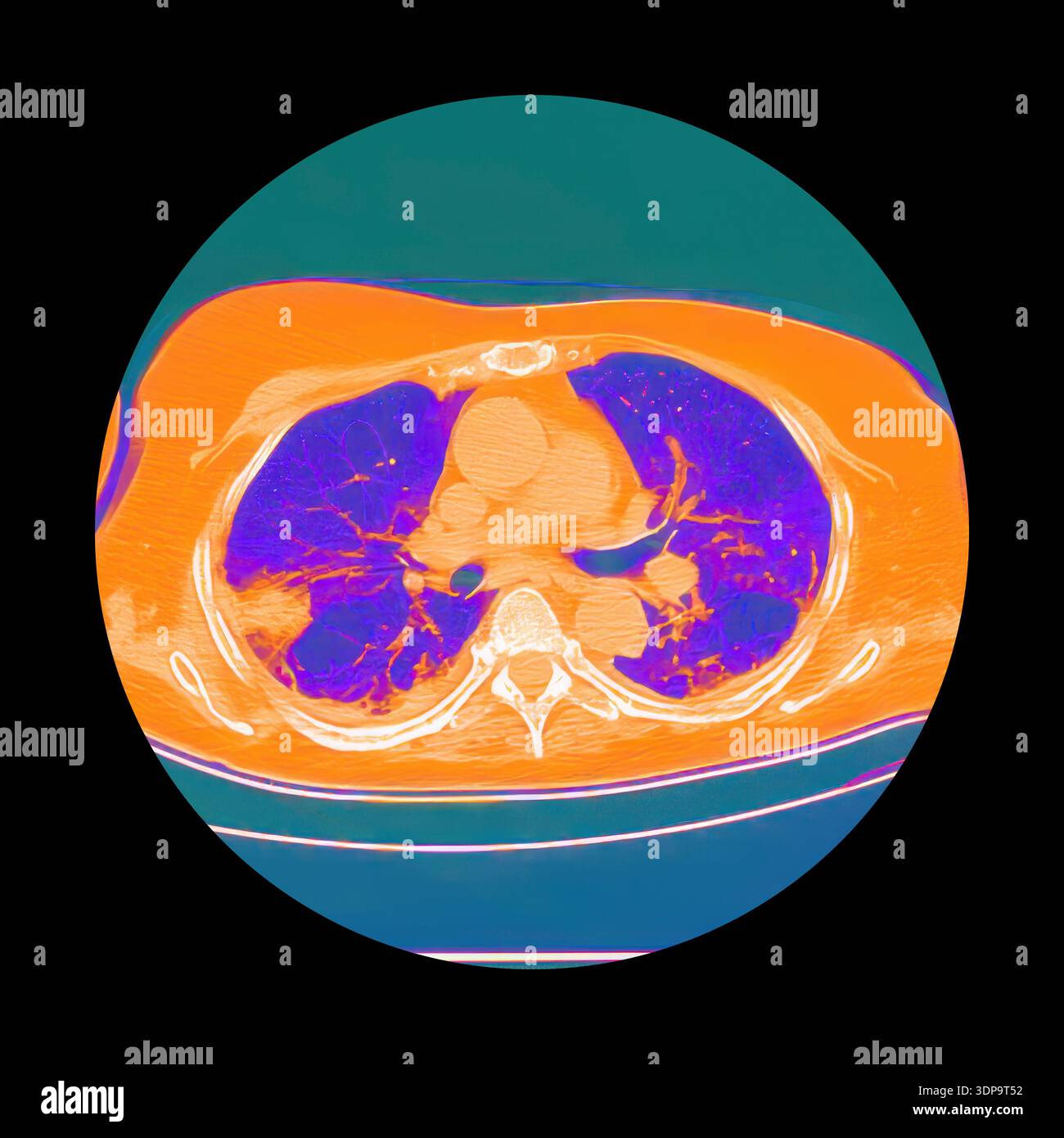 Lng Infarction Pulmonary embolism ct scan hi-res stock photography and images - Alamy