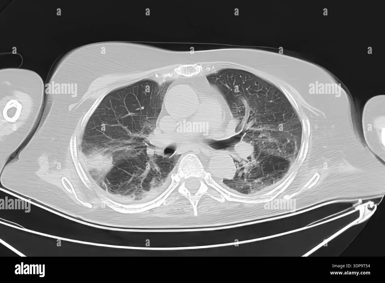 Wedge Infarction CT scan showing wedge-shaped pulmonary infarction in the right lung ...