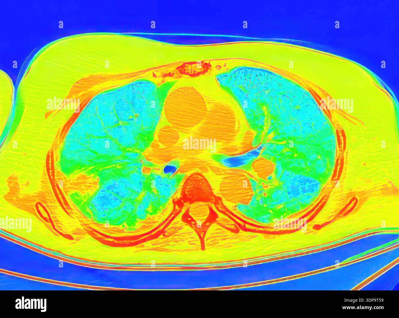 Peripheral Scan Pulmonary embolism ct scan hi-res stock photography and images - Alamy