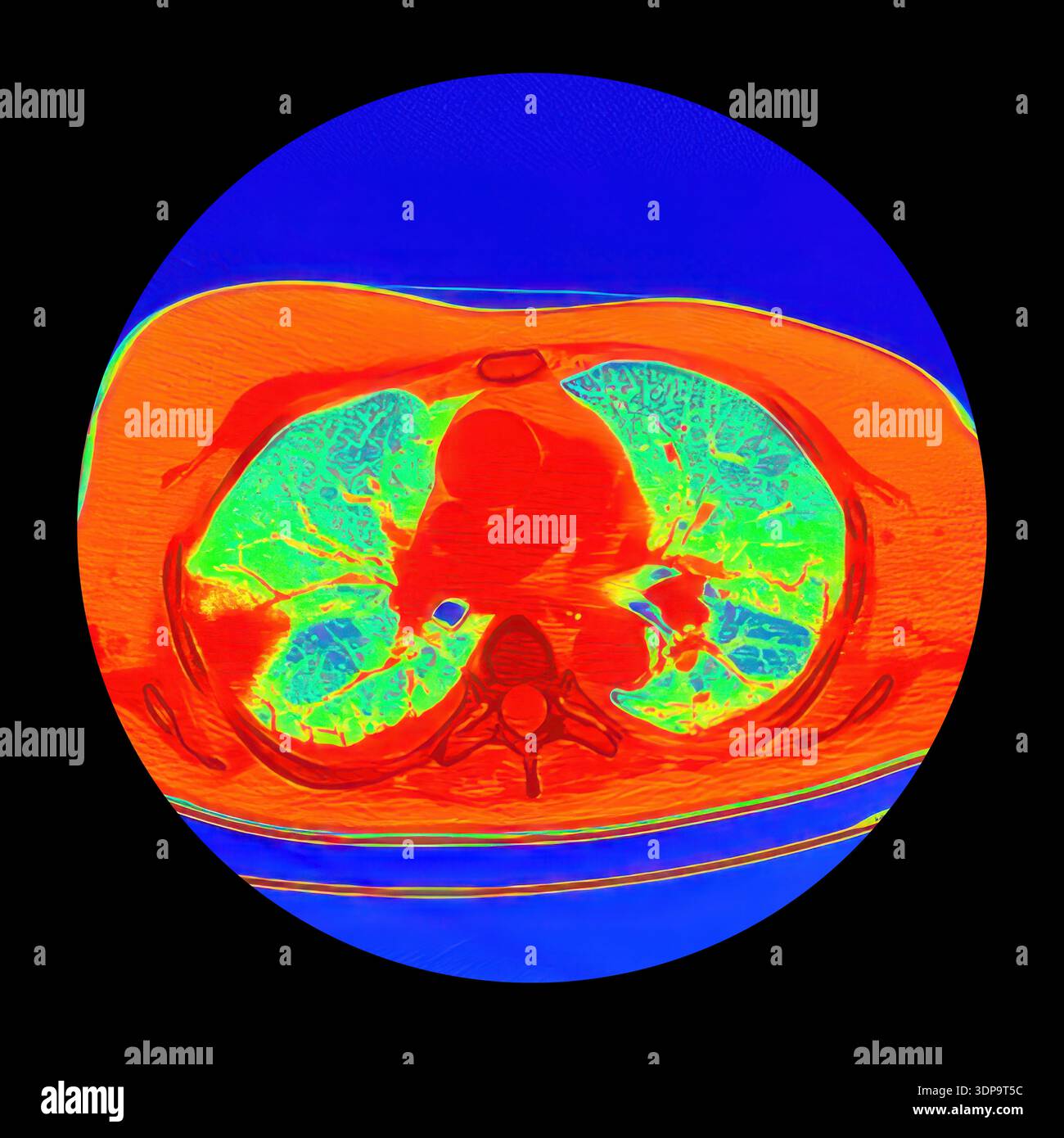 Peripheral Scan Colour-enhanced CT scan showing wedge-shaped pulmonary infarction in ...