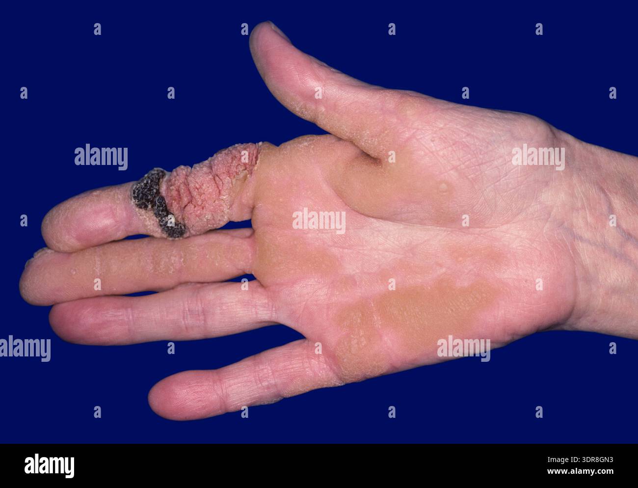 Viral wart caused by human papillomavirus on the finger of a 36-year-old female patient. Stock Photo