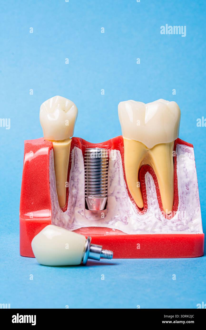Tooth Place Dental implant model illustrating an artificial tooth replacement, with ...