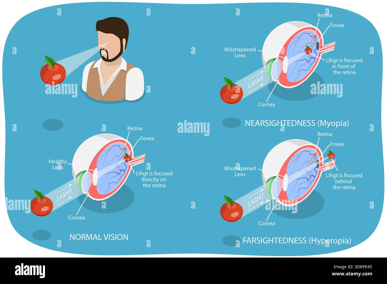 3D Isometric Flat Vector Illustration of Vision Disorder Stock Photo ...