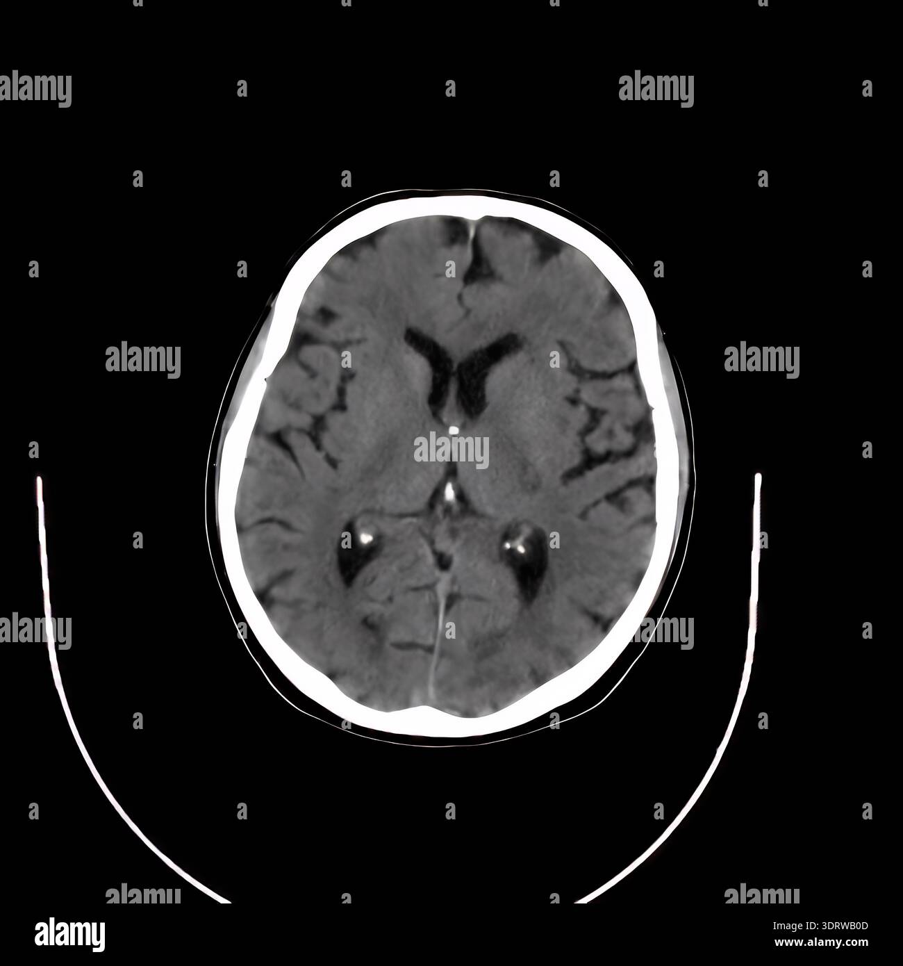 Human head CT scan presenting cranial anatomy including brain tissue ...