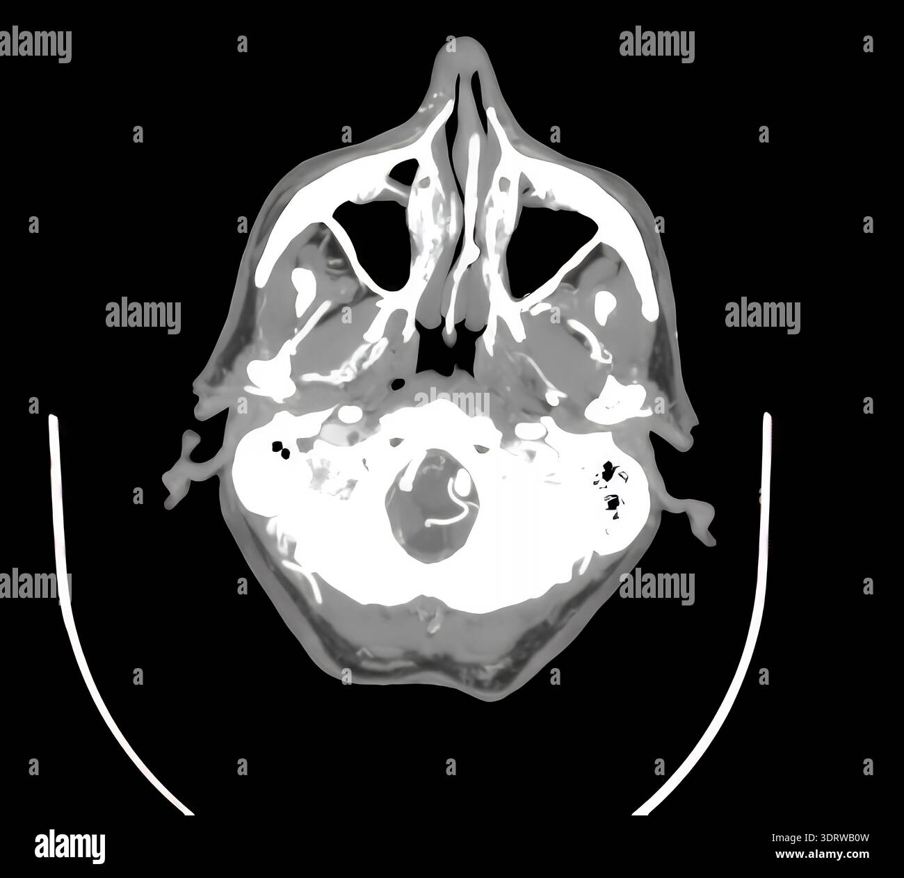 CT scan of human head showing skull, brain, sinuses, orbits and blood vessels in cross sectional views for diagnostic, anatomical and clinical study o Stock Photo