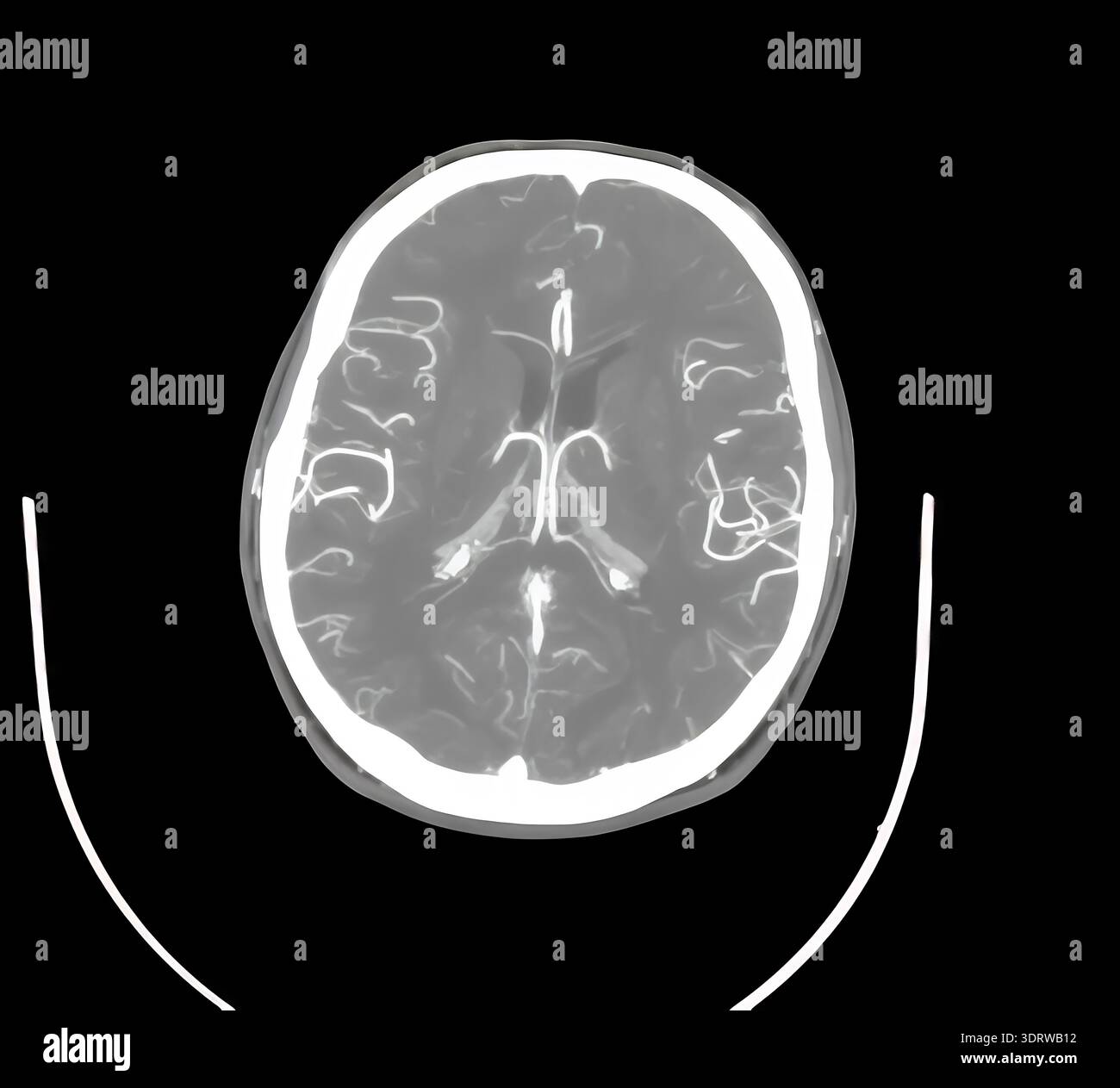 CT scan of human head showing skull, brain, sinuses, orbits and blood vessels in cross sectional views for diagnostic, anatomical and clinical study o Stock Photo